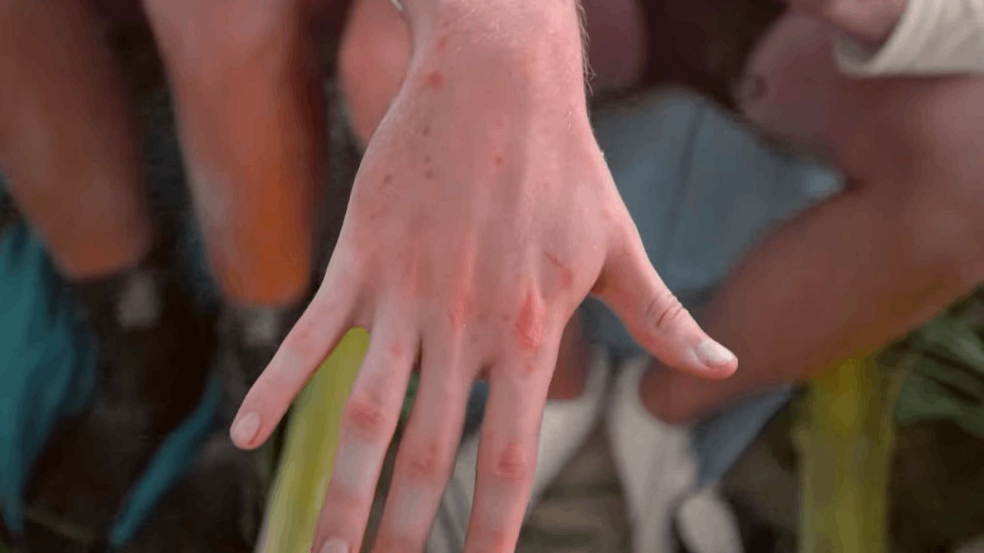 Bug bites on Jimmy&#039;s right hand (Image via MrBeast/YouTube)