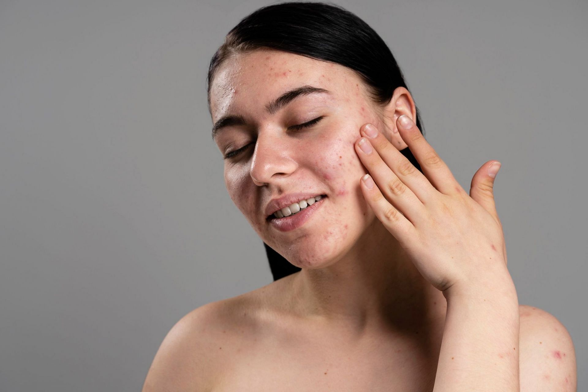 Get rid of oily skin with these best soaps for oily skin (Image by Freepik)