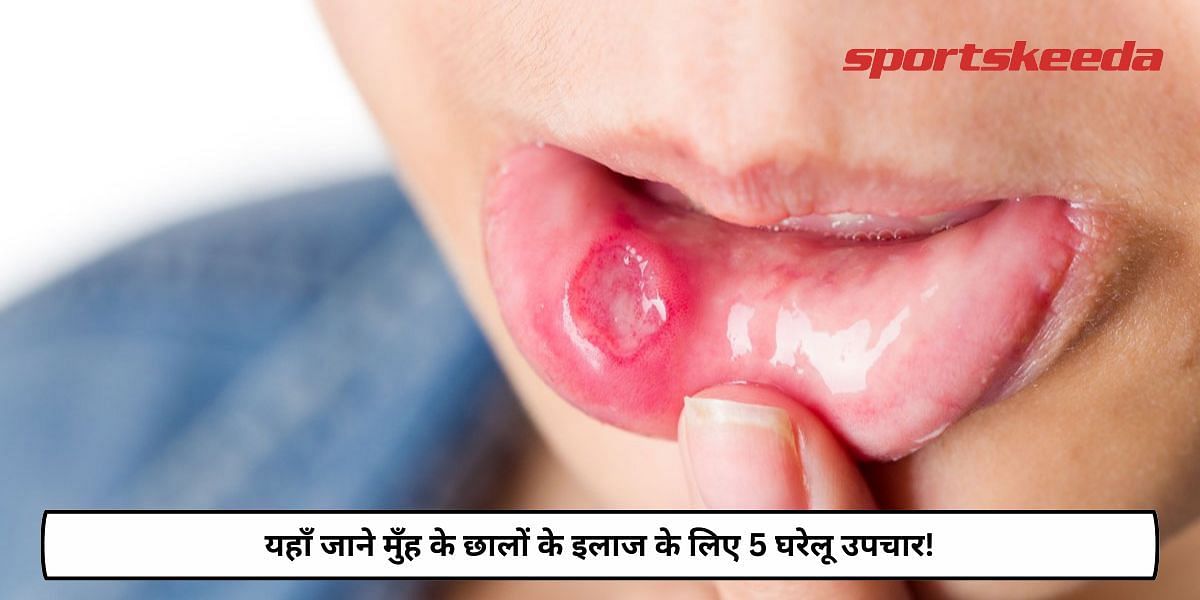 5 Home Remedies For Treating Mouth Ulcers!