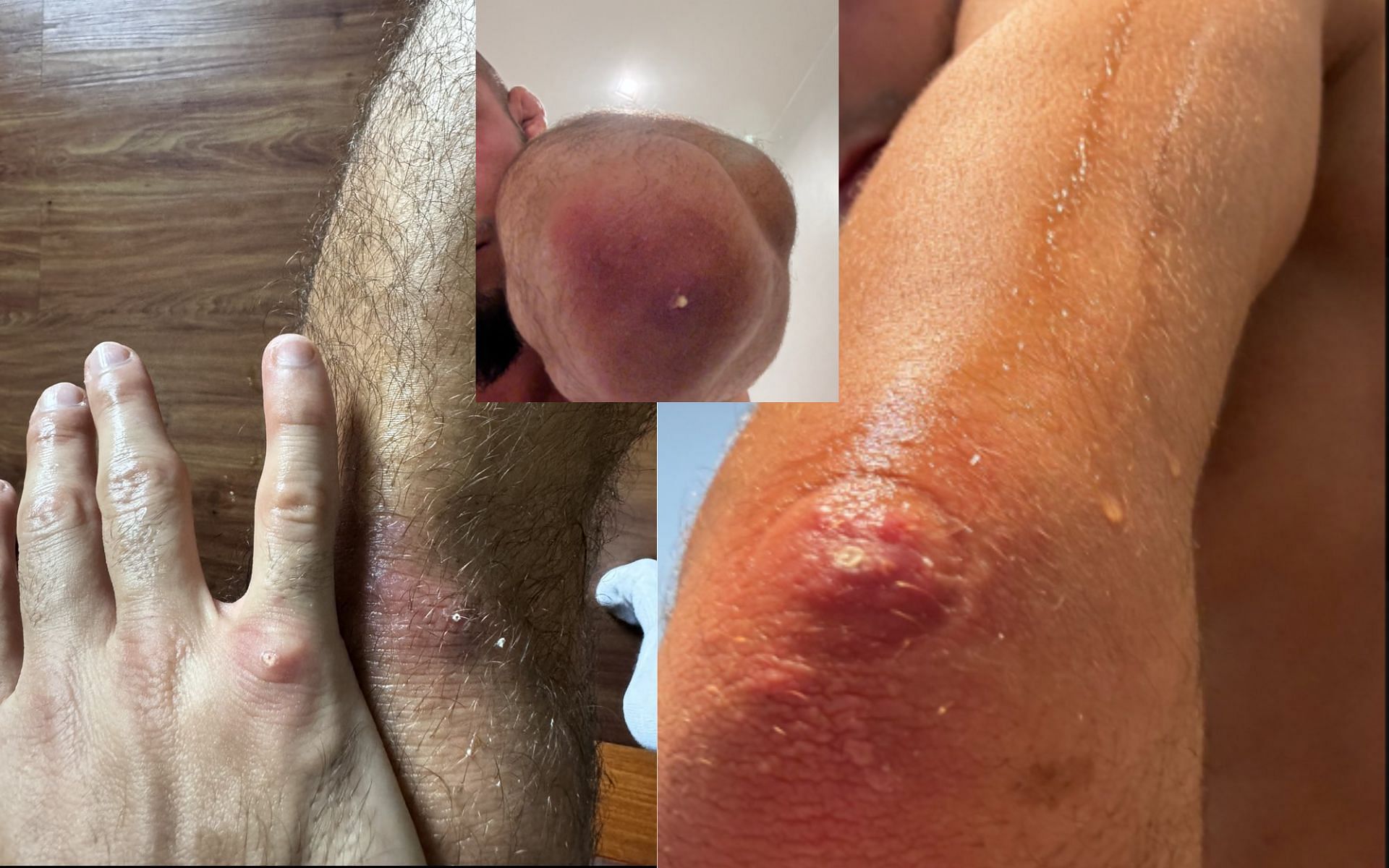 Pictures of Muhammad Mokaev&#039;s staph infection [Via: @muhammadmokaev on X]