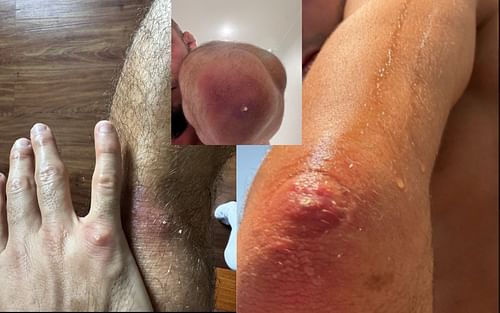 Pictures of Muhammad Mokaev's staph infection [Via: @muhammadmokaev on X]