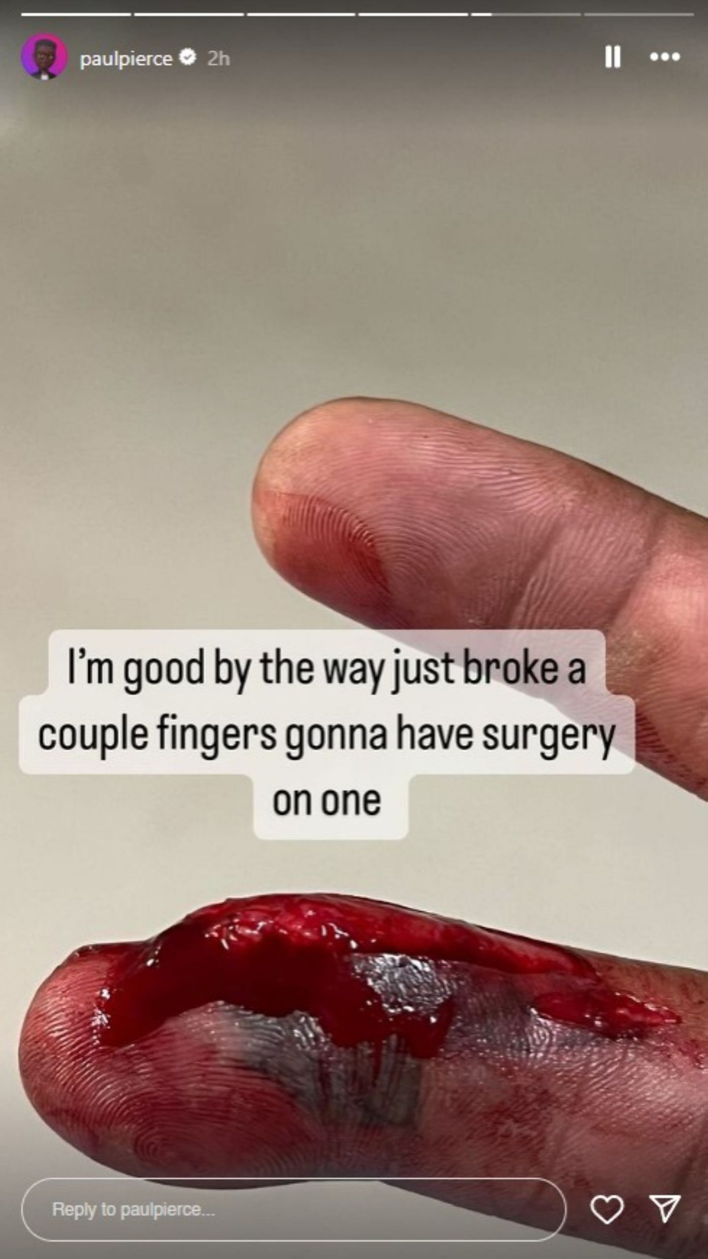 Pierce&#039;s injured finger posted on IG