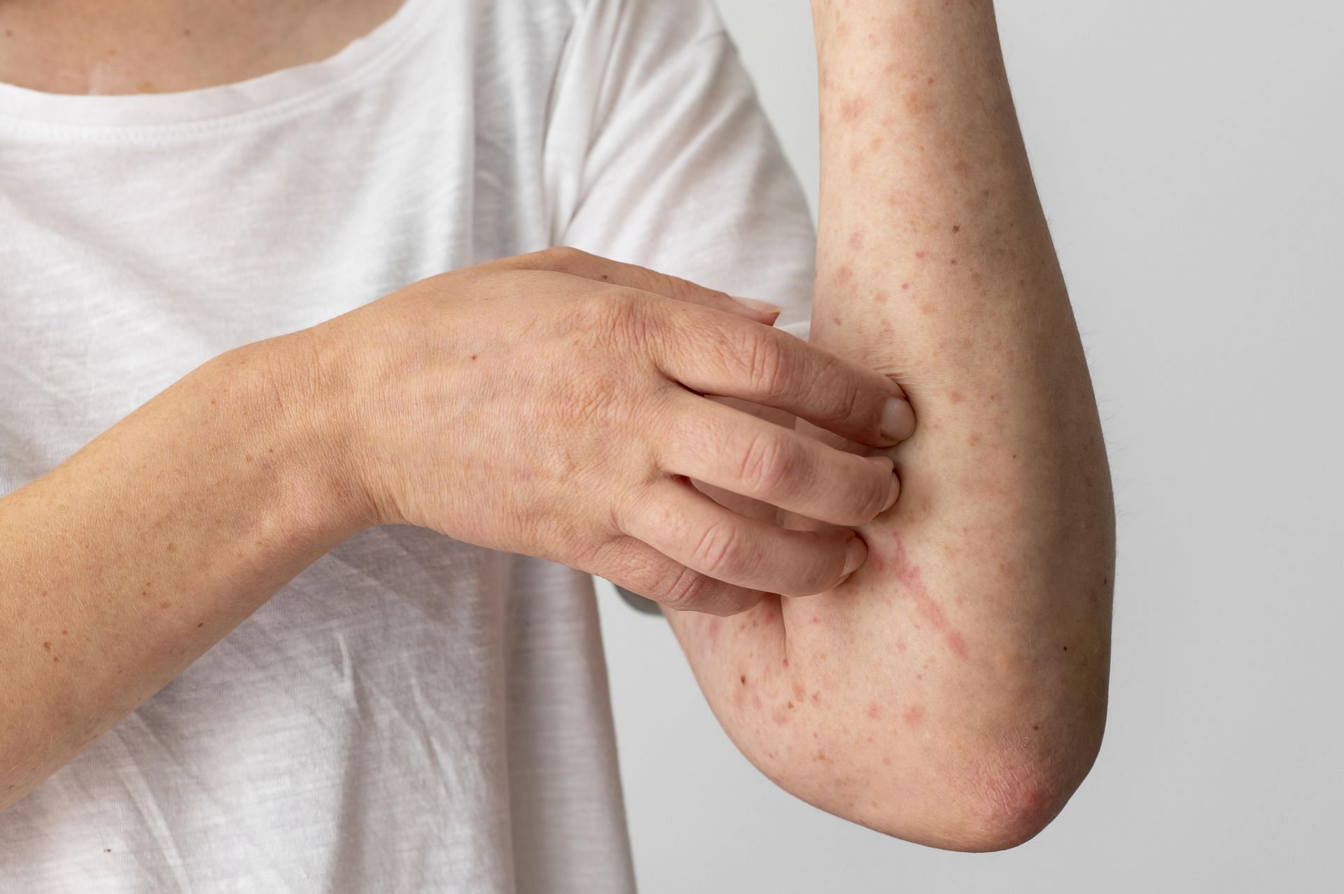 Red skin rash (Image via Freepik)