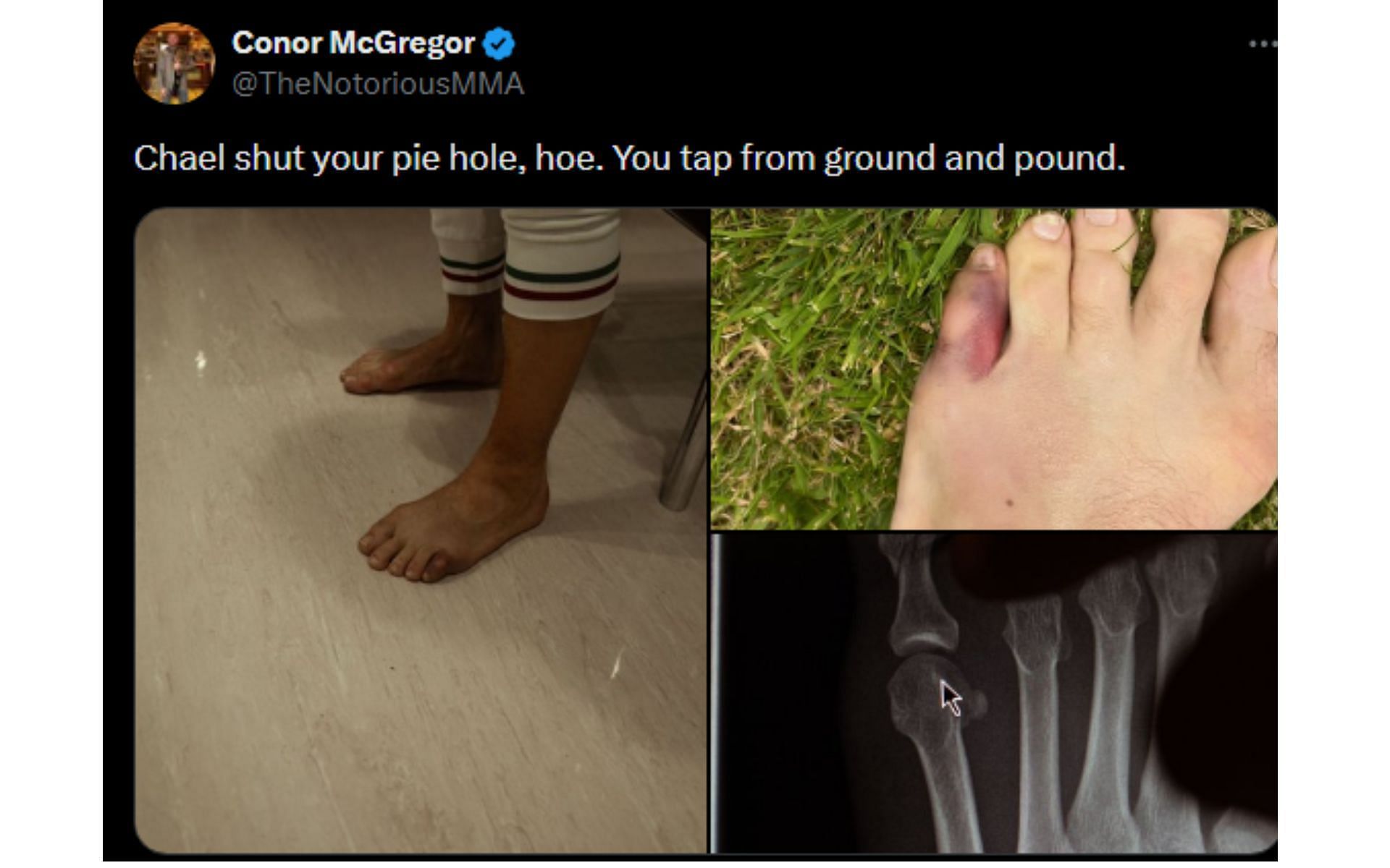 McGregor&#039;s tweet regarding his injury and Sonnen [Image courtesy: @TheNotoriousMMA - X]