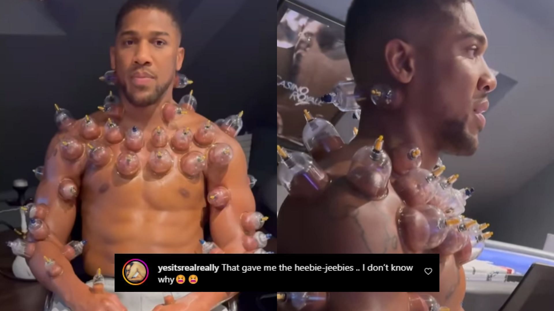 Fans react to Anthony Joshua undergoing extreme cupping therapy session [Images courtesy of @anthonyjoshua on Instagram]