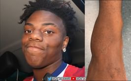 IShowSpeed's cameraman releases pictures of the streamer's injury following the recent controversy in Norway
