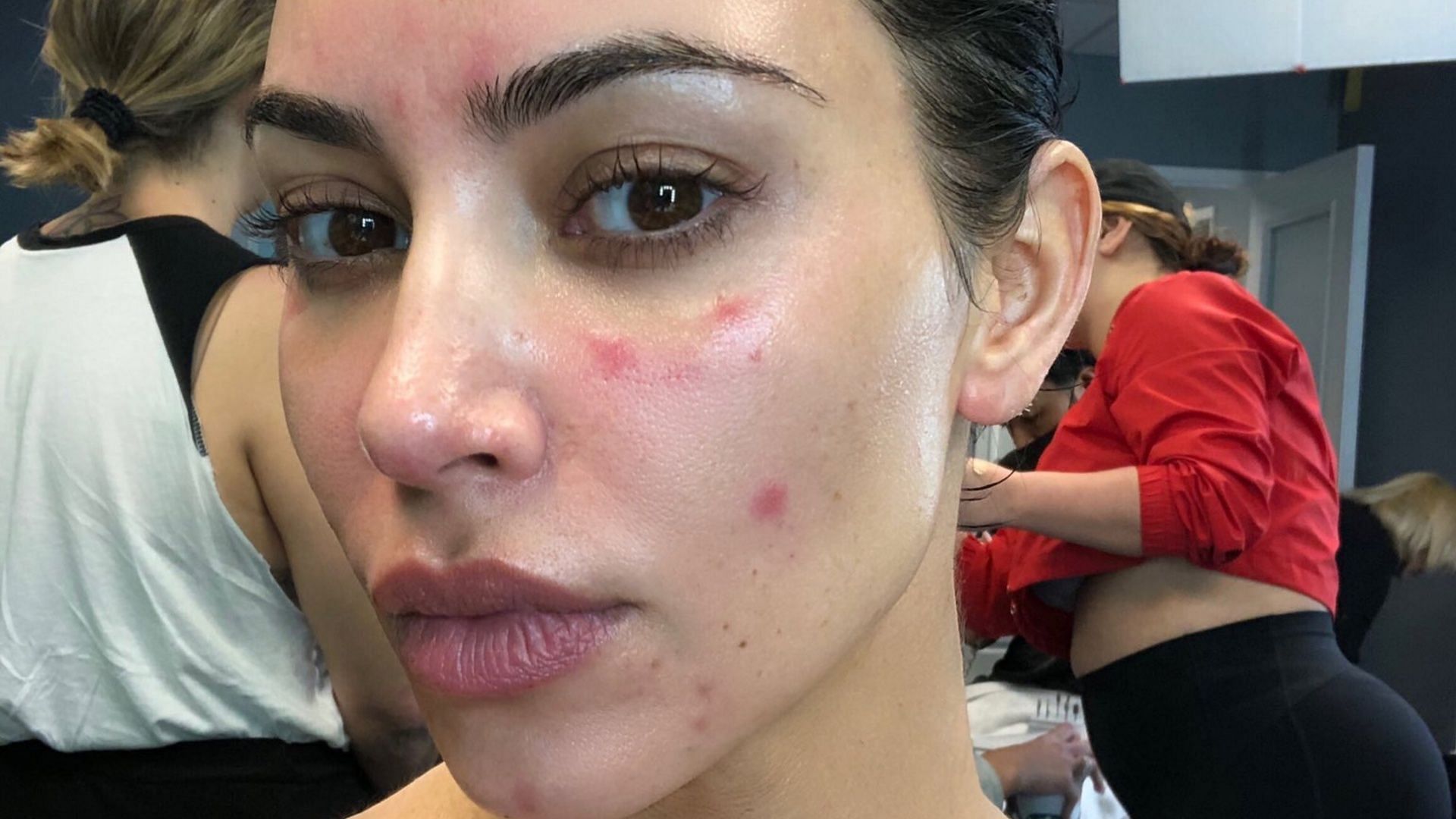 Kim Kardashian suffers from Psoriasis (Image via X/@KimKardashian)