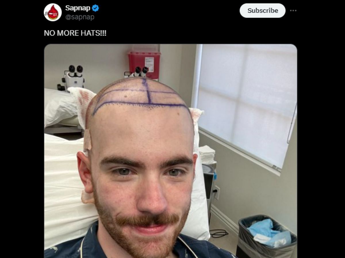 Sapnap reveals hair transplant surgery (Image via X)