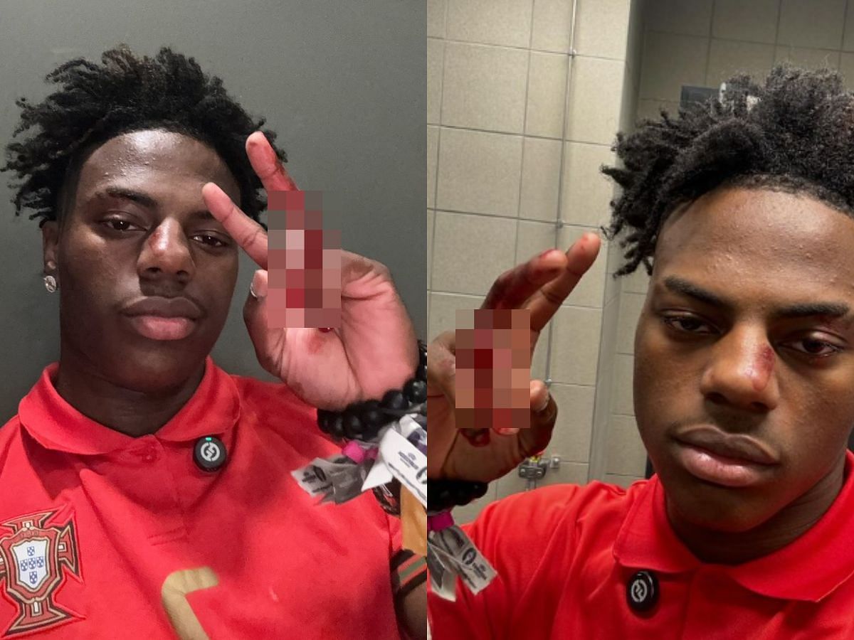 Speed shared images of his injured hand (Images via X and Instagram/IShowSpeed)