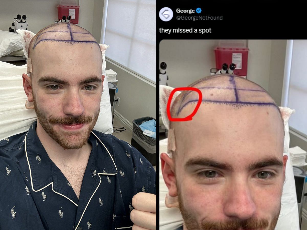 Sapnap reveals getting a hair transplant surgery, GeorgeNotFound reacts (Image via X/Sapnap and GeorgeNotFound)