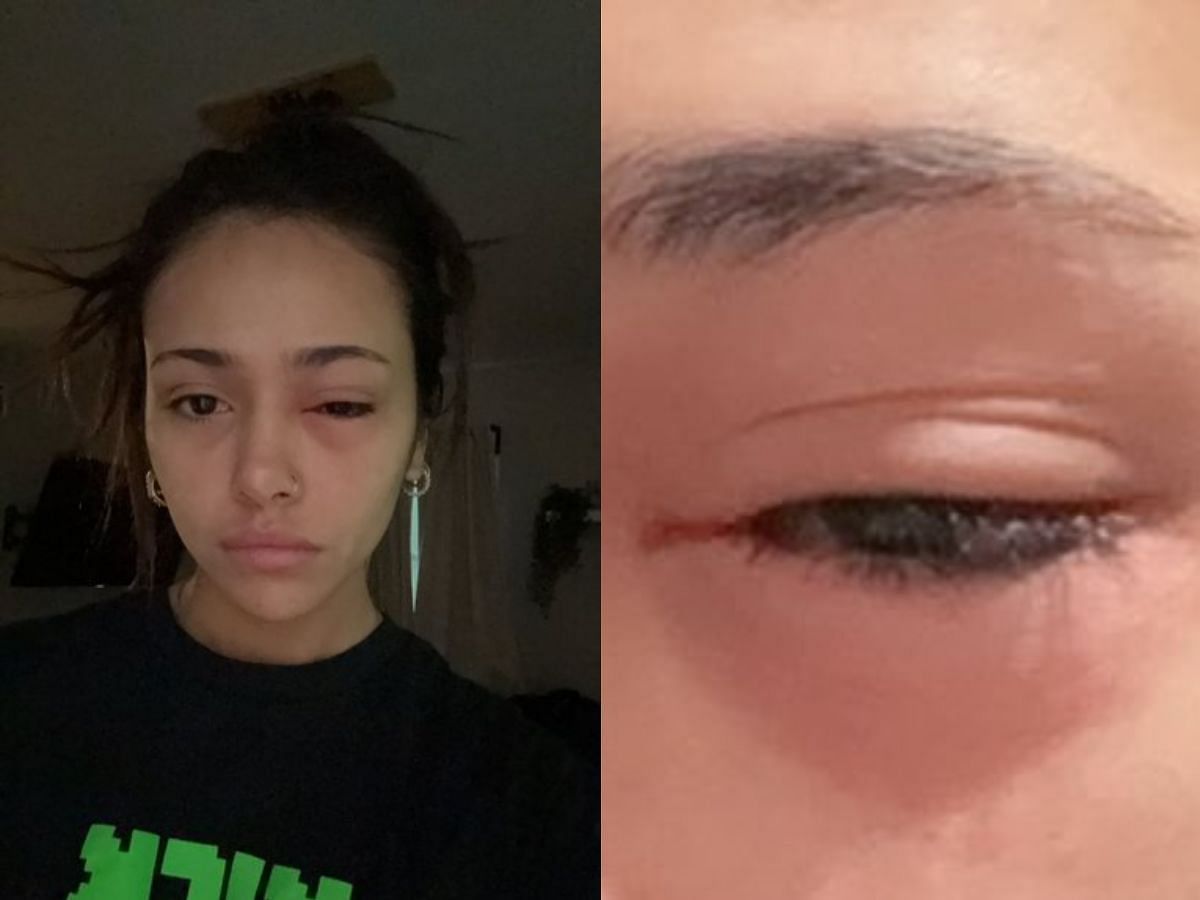 Demisux shares images of her infected eye (Image via X/Demisux)