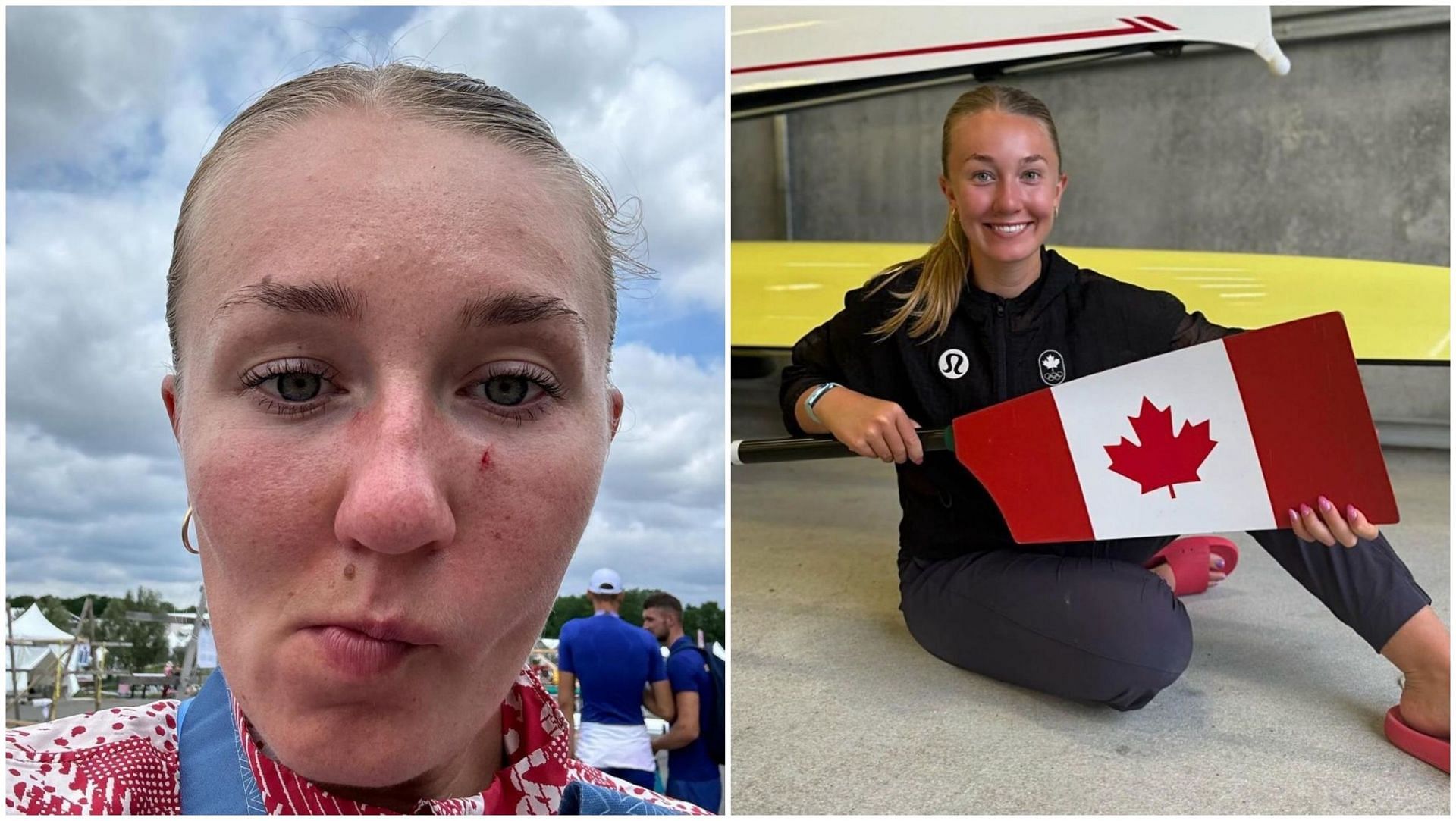 Maya Meschkuleit with the shiner sustained from the Olympics