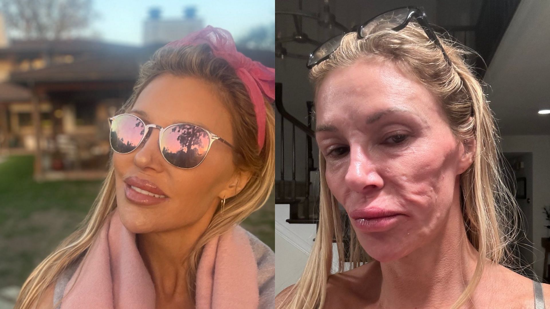 Brandi Granville on suspected facial parasite (Image via @brandiglanville/X, Instagram)