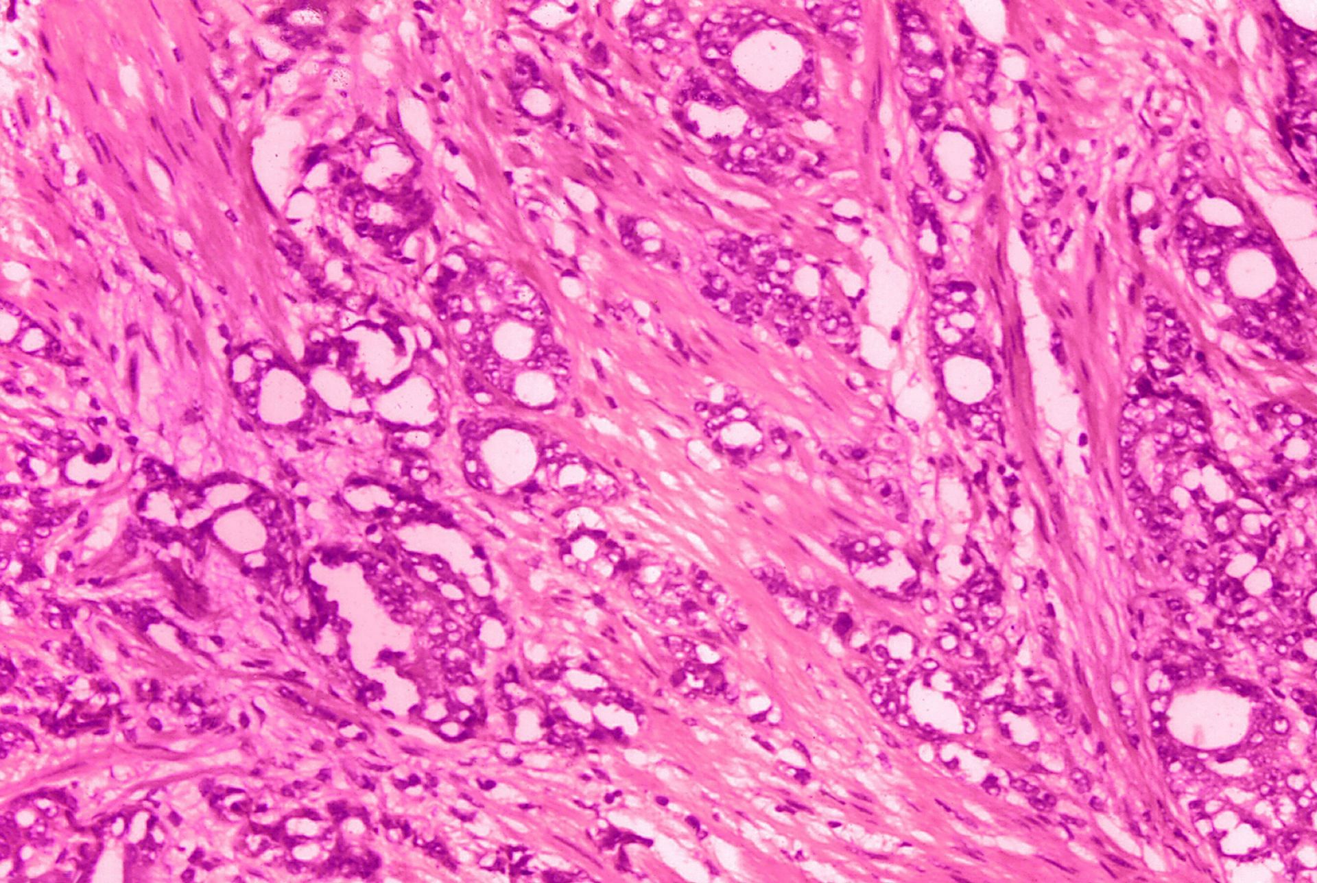 Adenocarcinoma accounts for 90-95 percent of stomach cancers. (Image via Getty Images).