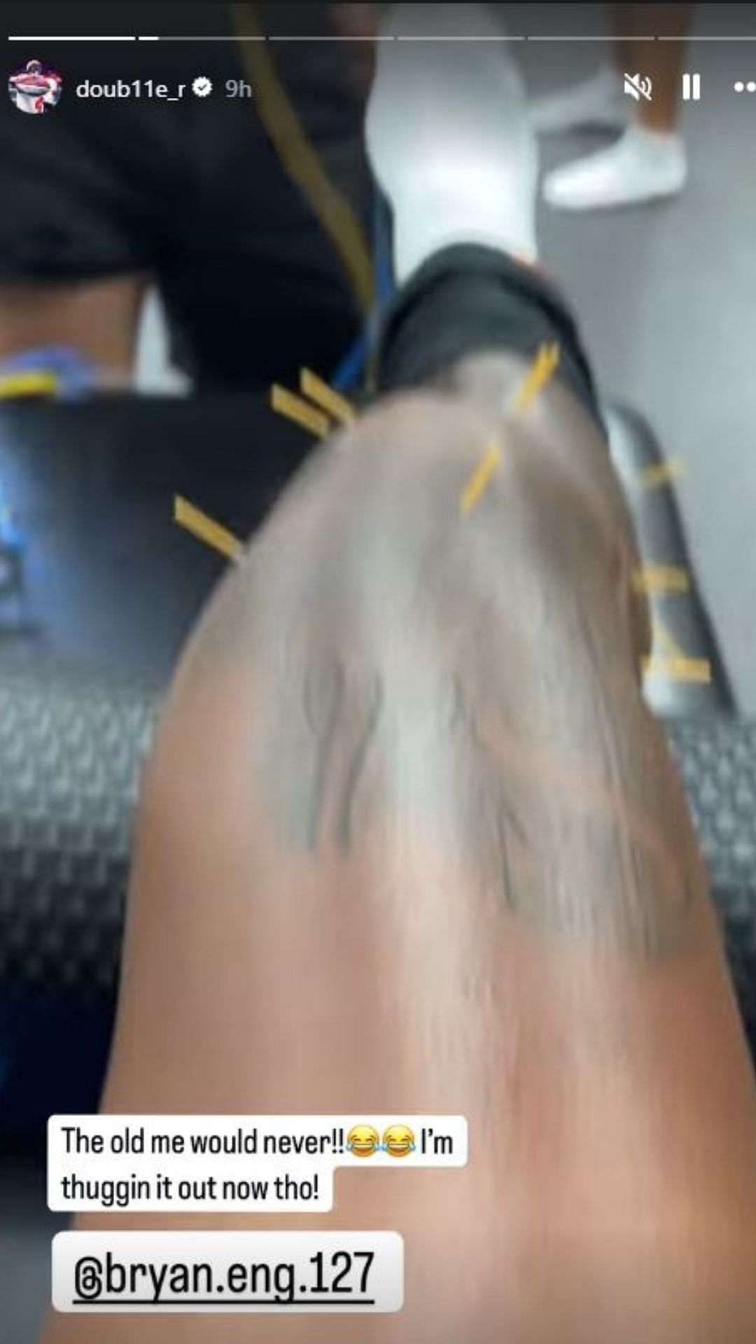 Rashee Rice gives a sneak peek into his acupuncture sessions for his injured knee. (Credits: IG/Rashee Rice)