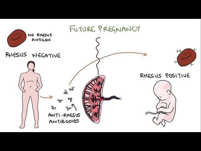 What is Rhesus disease? Blood donor James Harrison known as ‘The Man ...