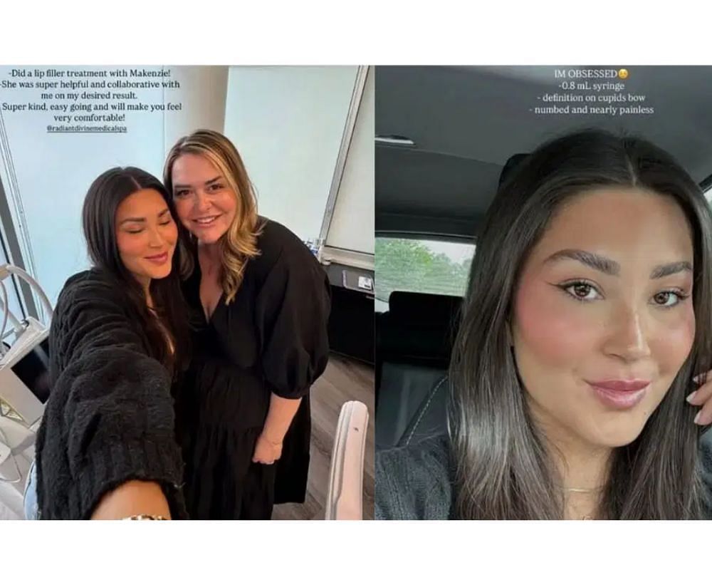 Zo Caswell shares lip filler experience and transformation with her followers on Instagram [IG/@zocaswell]