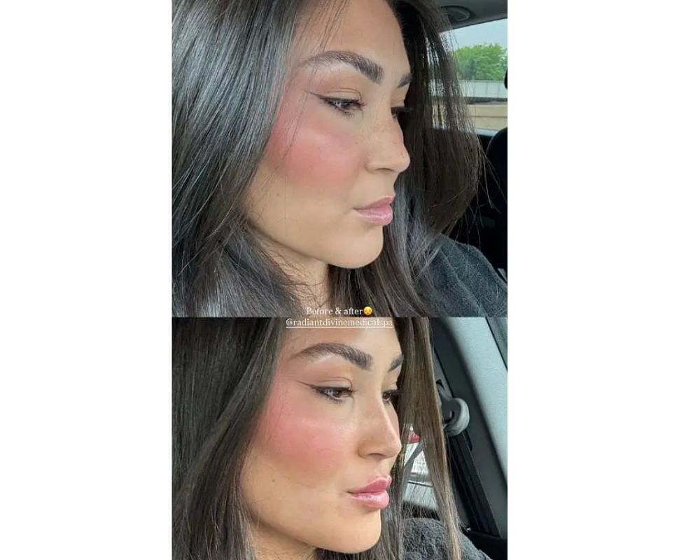 Zo Caswell shares lip filler experience and transformation with her followers on Instagram [IG/@zocaswell]