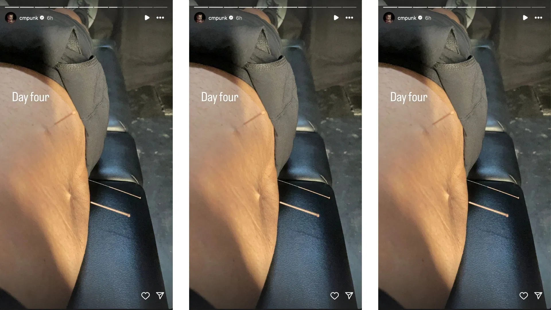 Punk reveals minor procedure on Instagram. [Image credit: CM Punk on Instagram]