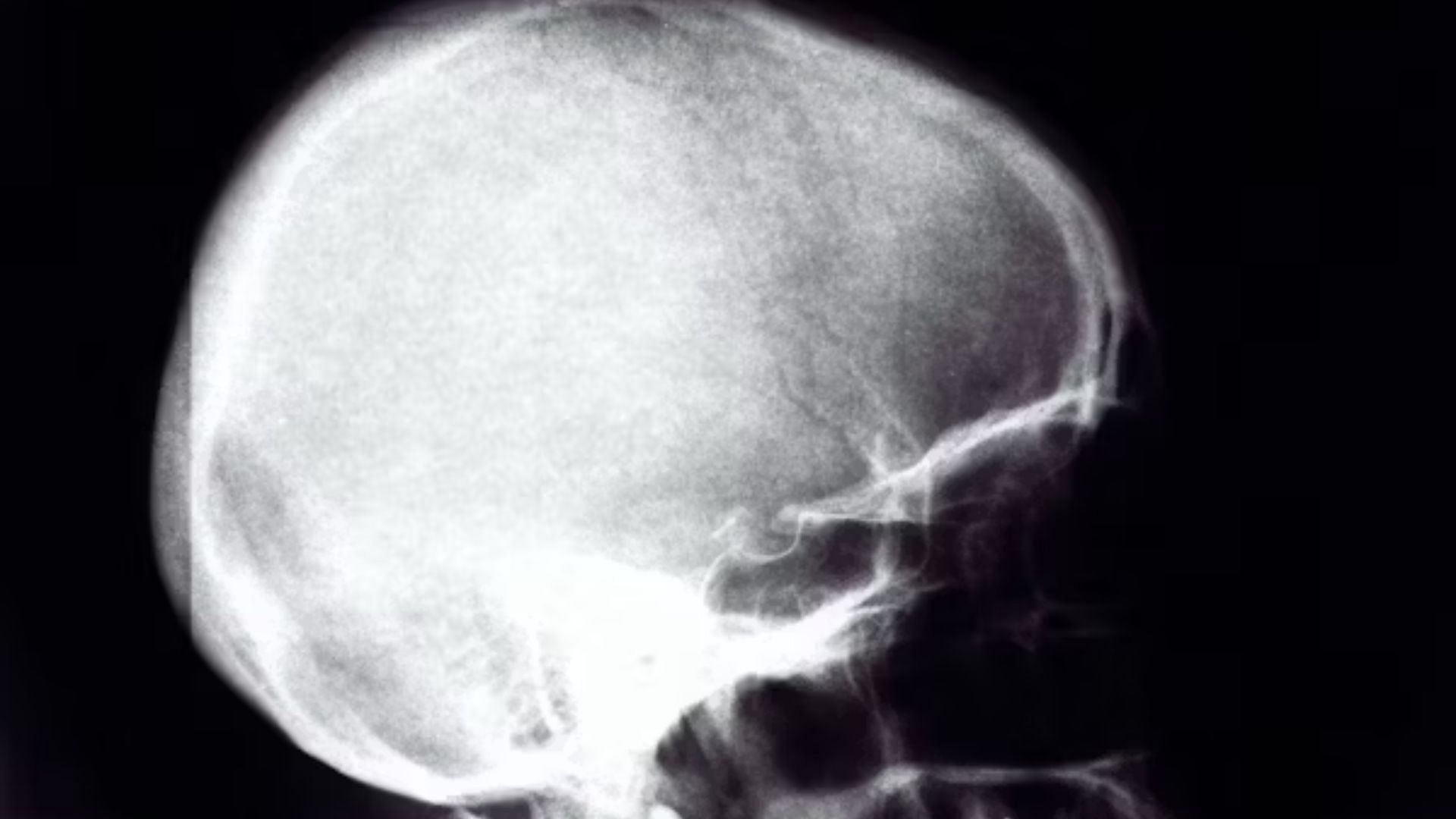 Dr. Nancy Jones suggested Benjamin had chronic cerebral swelling. (Representative image via Unsplash/ @ Risto Kokkonen)