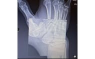 Dream shared a picture of an X-ray of his broken wrist (Image via YouTube.com/@dream)