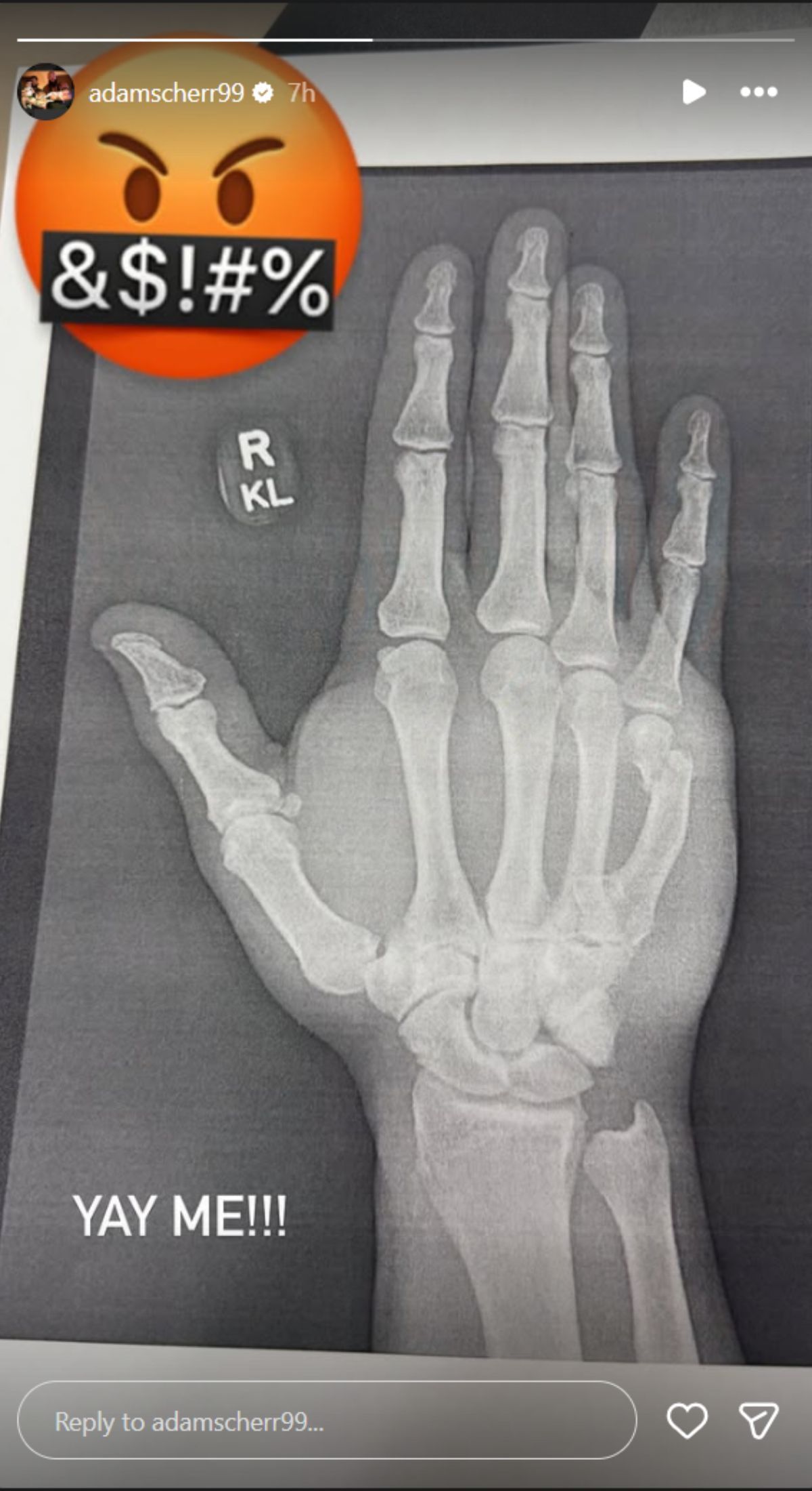 Braun Strowman shared an X-ray scan [Picture credits: star&#039;s Instagram story]