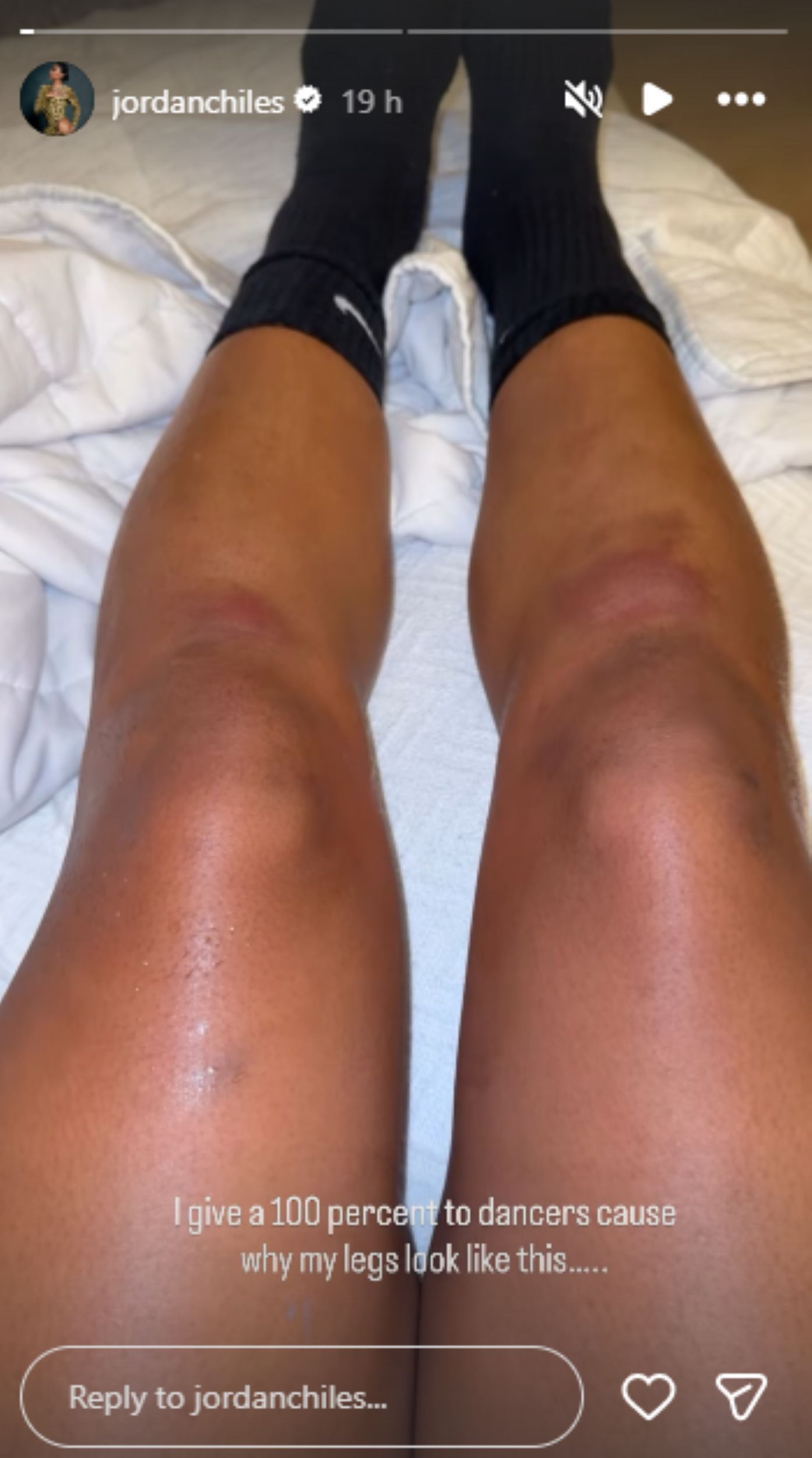 Screengrab of Jordan Chiles&#039; bruised legs [Image Source : Jordan Chiles&#039; Instagram]