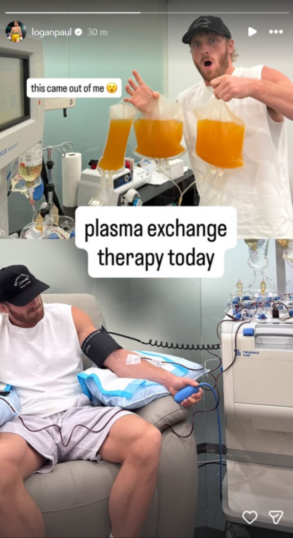 Logan Paul undergoes plasma exchange therapy. (Picture credits: Star&#039;s Instagram Story)
