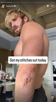 Logan Paul showing off his scar. (Image via Instagram/@loganpaul)