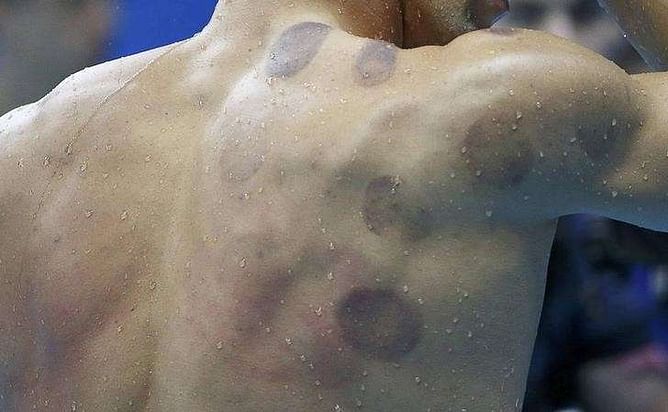 Michael Phelps' purple blotches spotlight 'cupping' trend