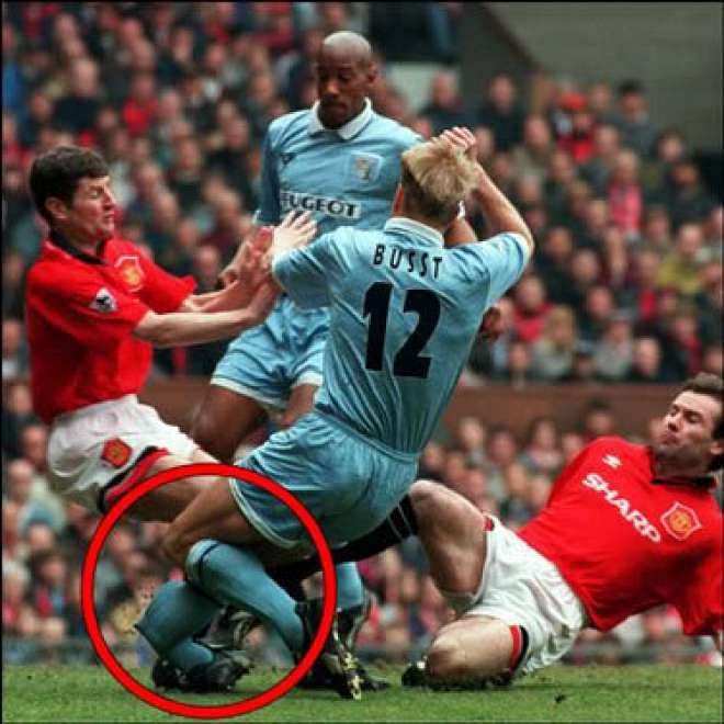 David Busst suffered compound fractures to the bones in his leg.
